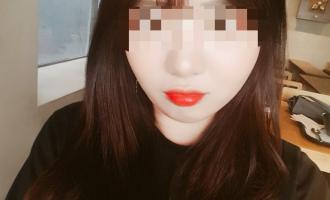 사각턱보톡스+V라인주사 후기사진2장