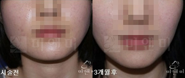 [시술전후사진]사각턱보톡스 시술전후