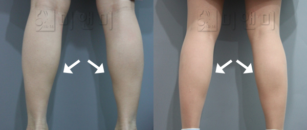 종아리 보톡스로 부피감소